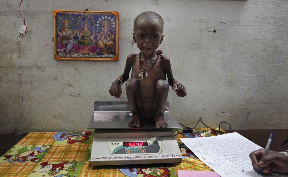 2 year-old Rajni, who is severely malnourished, is weighed at a clinic in central India