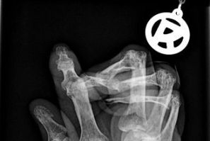 Arthritis Hands X-Ray