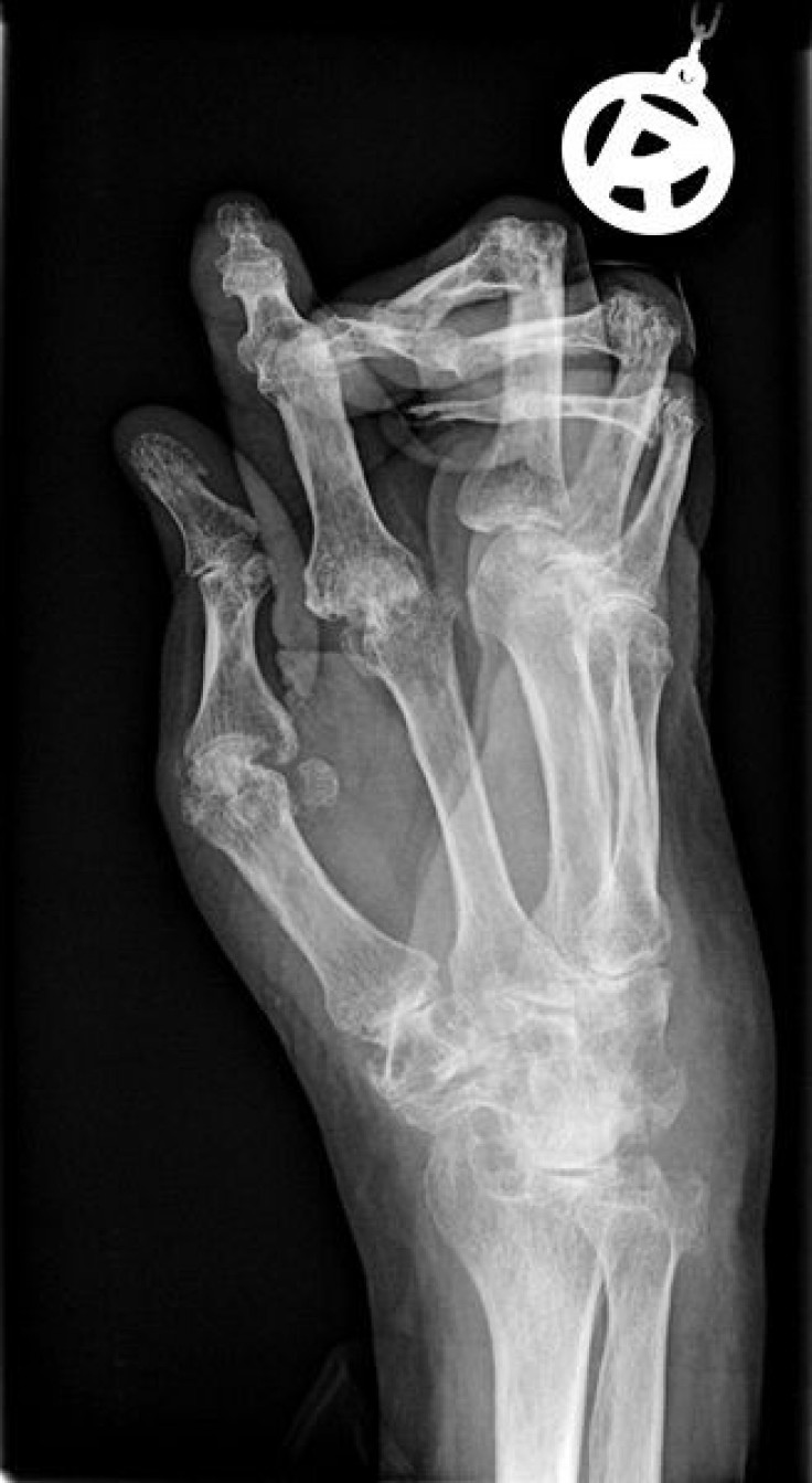 Arthritis Hands X-Ray