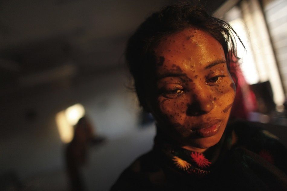 Asma Begum, a survivor of an acid attack, waits for treatment at the burn unit of the Dhaka Medical College in Dhaka