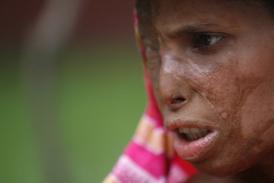 Khodeza Begum attends an international conference of acid survivors in Dhaka