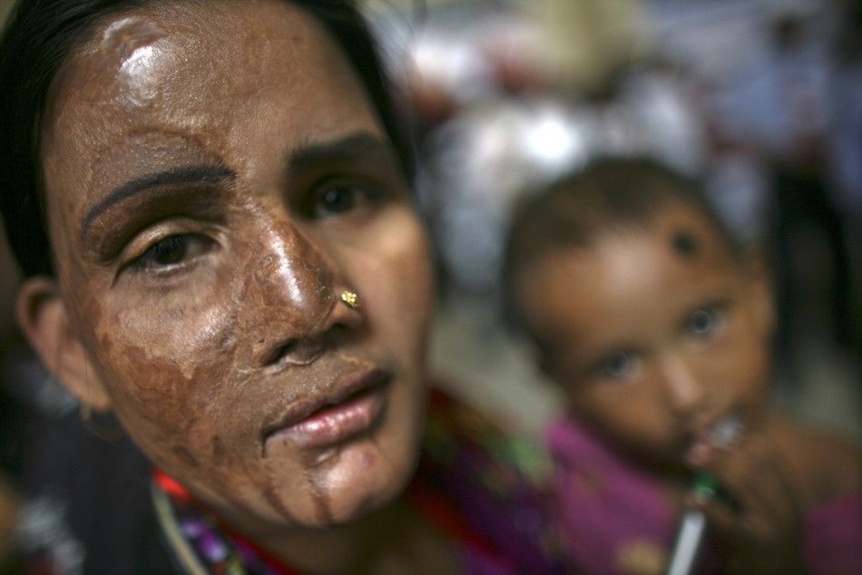  A survivor of an acid attack attends a rally with her child in Dhaka