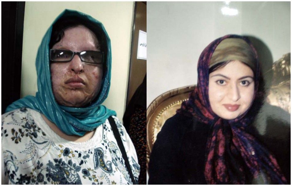 A combination photograph shows a woman identified as Ameneh before and after she was blinded with acid in an incident that happen in 2004 in Tehran