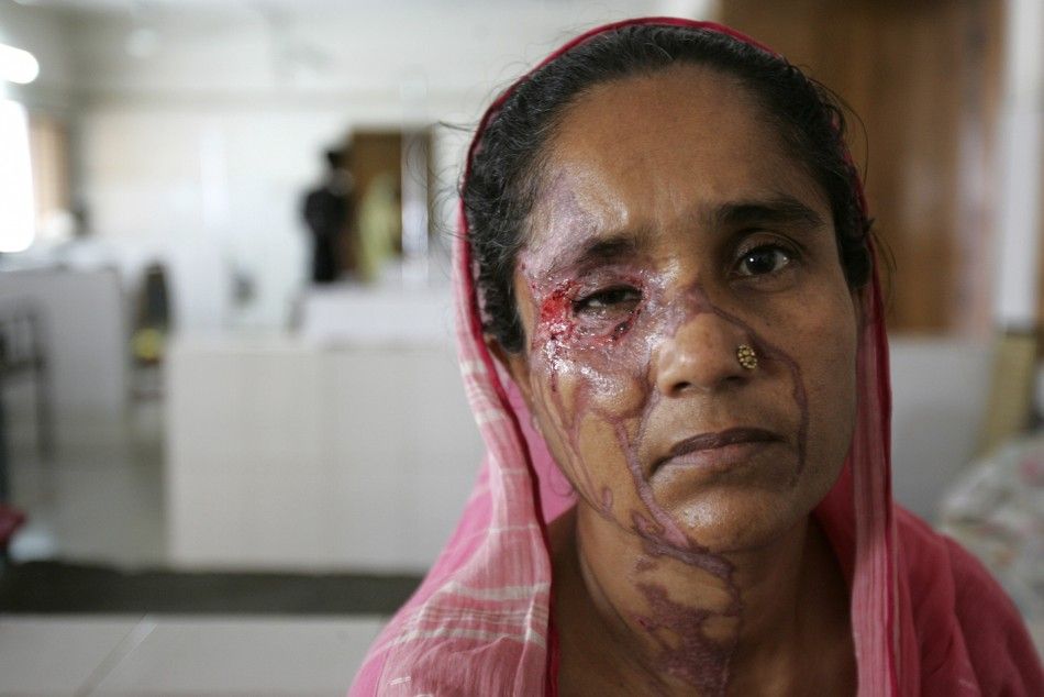 Acid victim Begum poses inside the Dhaka Medical College Hospital