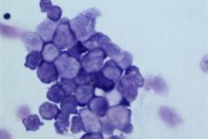 An image of malignant blood cells in the bone marrow (termed ''leukemic blasts'') of a patient with acute myeloid leukemia is seen in this handout photo.