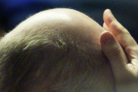 Baldness Trigger Found In Mice, May Lead To Human Treatments