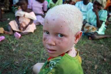 Tanzanian Child With Albinism