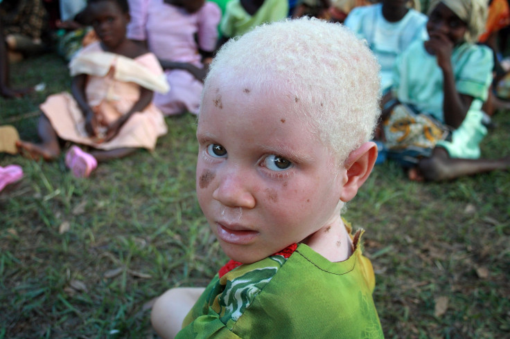 Tanzanian Child With Albinism