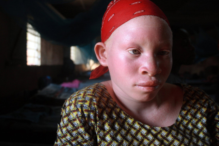 Tanzania Teen With Albinism