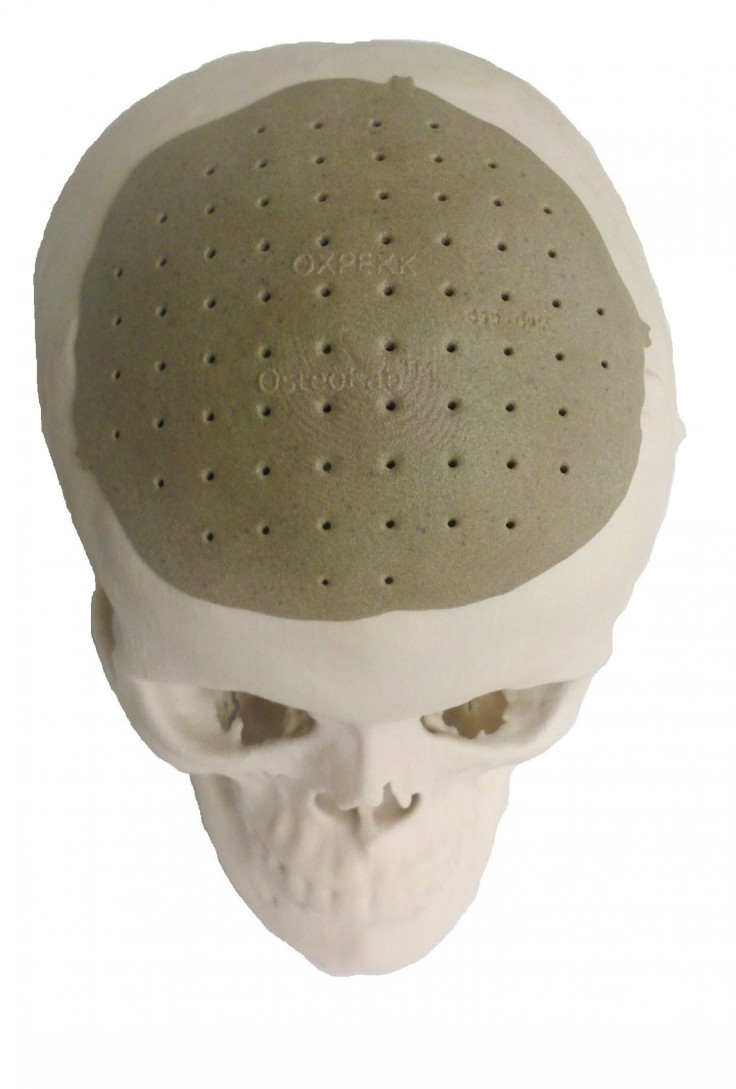 3d-printed-bone-replacement