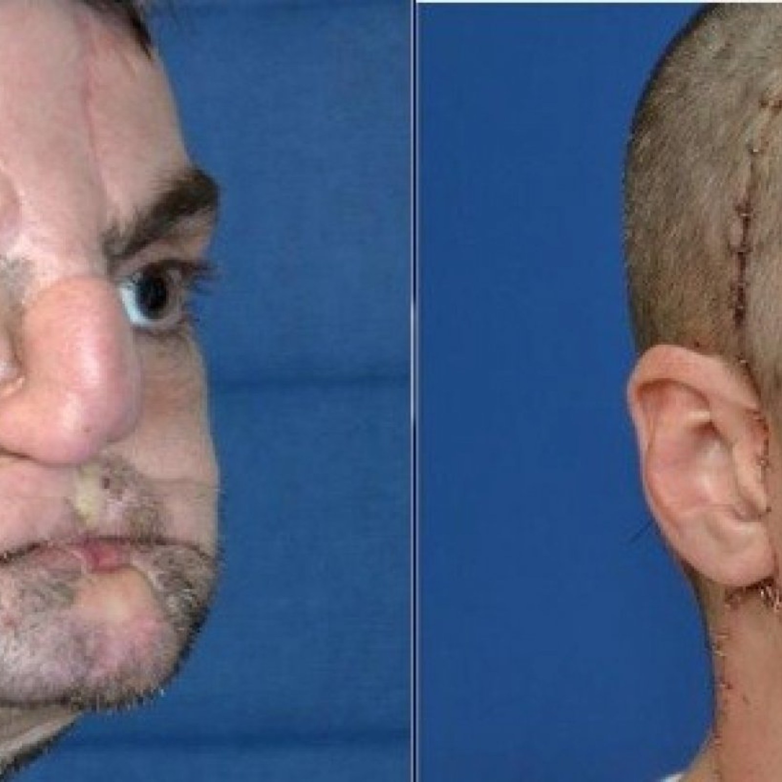 Richard Lee Norris Receives Face Transplant: 5 Other Face Transplant  Recipients [PHOTOS]
