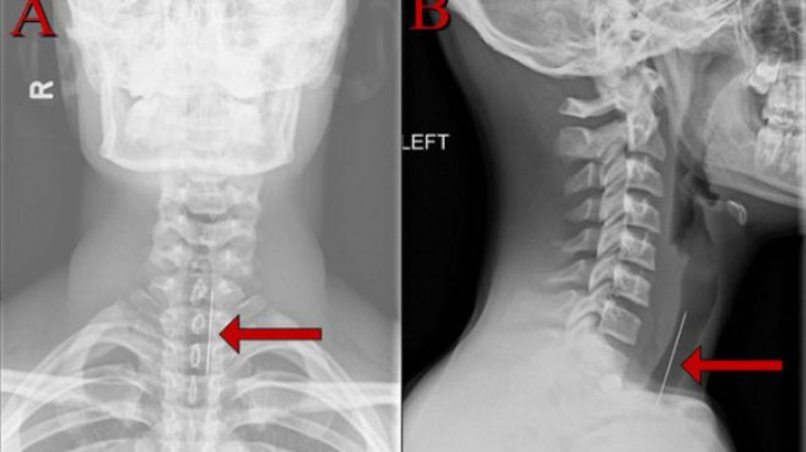 X-Ray Showing Inhaled Blowgun Dart