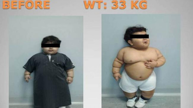 obese toddler gastric bypass