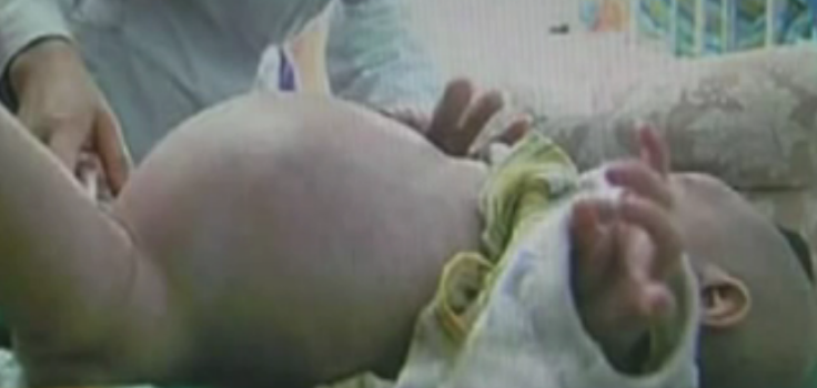 Toddler Gives Birth to Twin