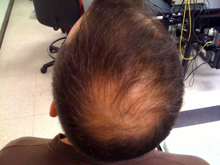 baldness-cure