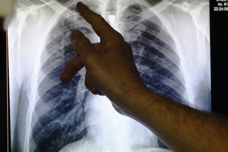 lungs ibtimes