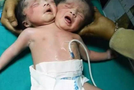 Baby Born With 2 Heads