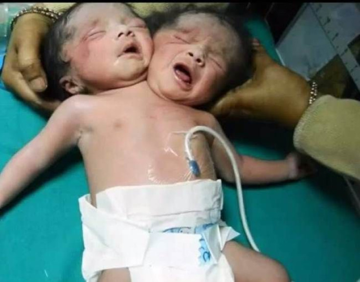 Baby Born With 2 Heads