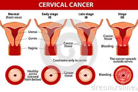 cervical-cancer-carcinoma-cervix-malignant-neoplasm-arising-cells-uteri-vaginal-bleeding-vector-diagram-35899452
