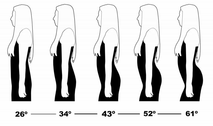 Spinal Curve