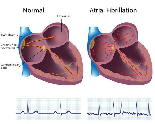 afib_heart
