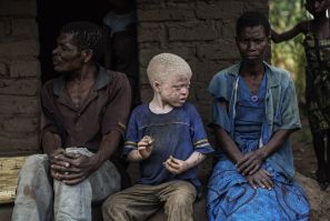 Albino child in Malawi