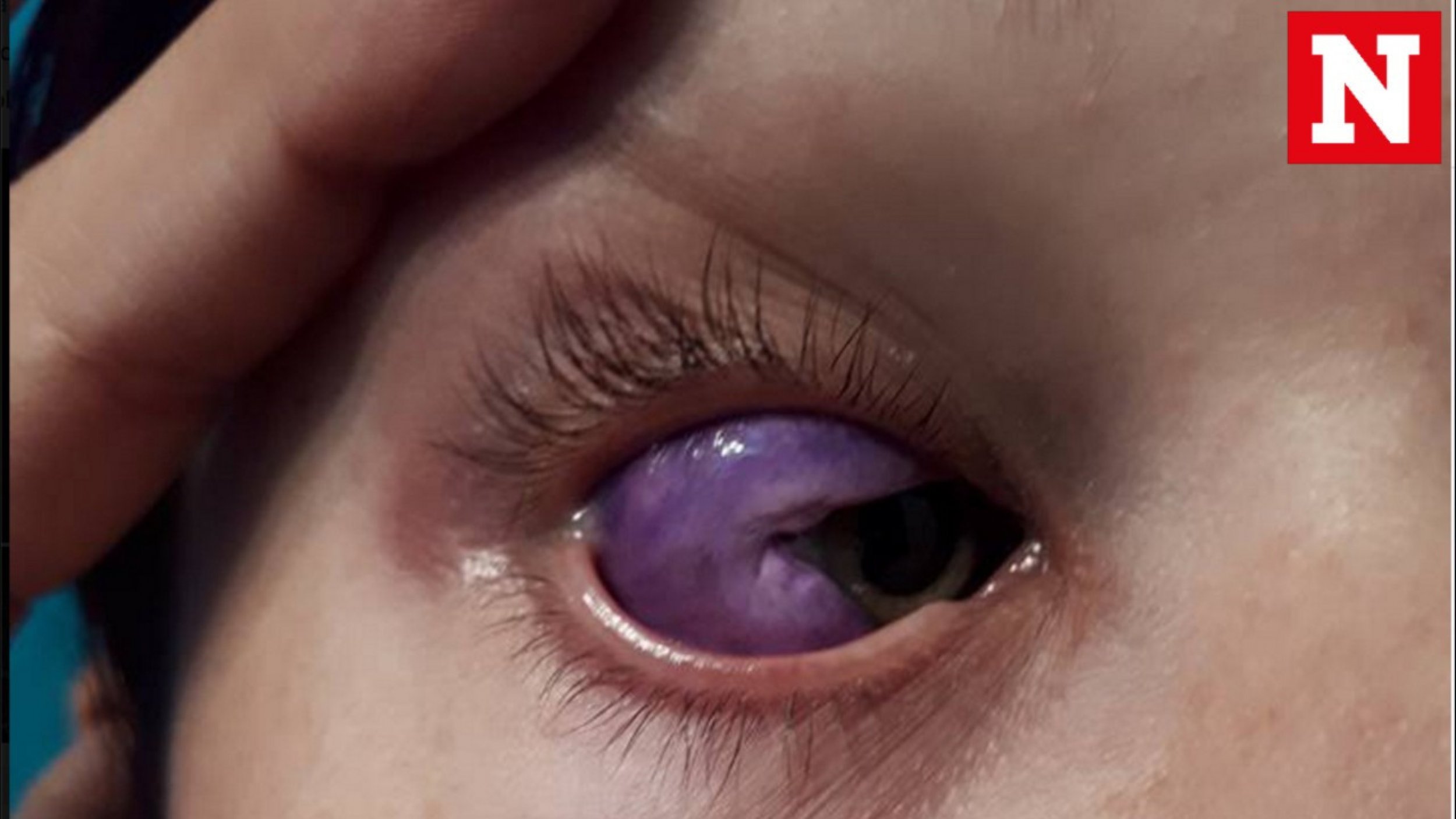 Eyeball Tattoos Are Even Worse Than They Sound - American Academy of  Ophthalmology