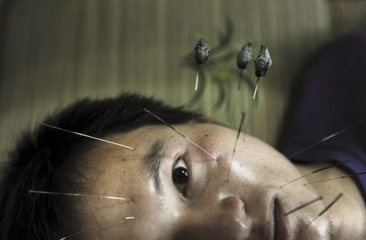 Acupuncture