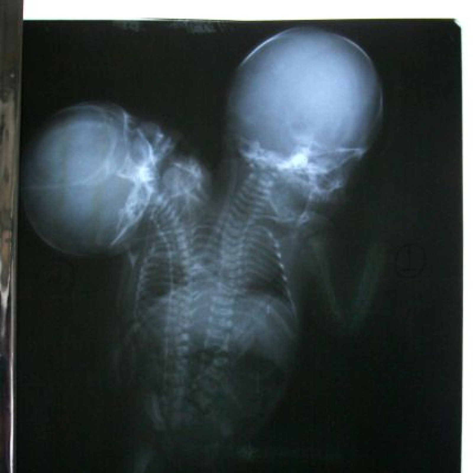 Conjoined Twins In The Womb