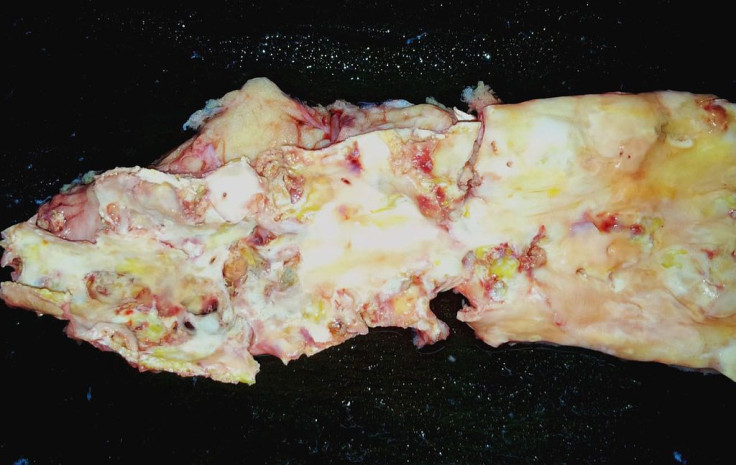 Atherosclerosis_of_aorta_1