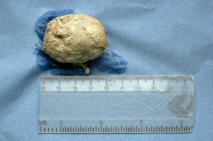 Bladder stone