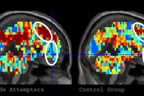 algorithm and brain scan suicide study