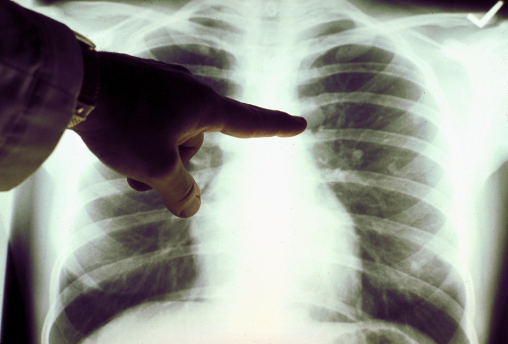 X-Ray