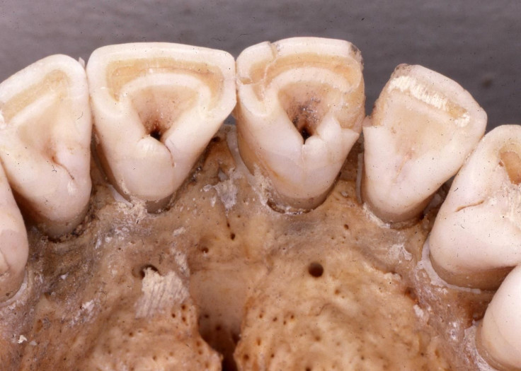 Shovel-Shapes Incisors