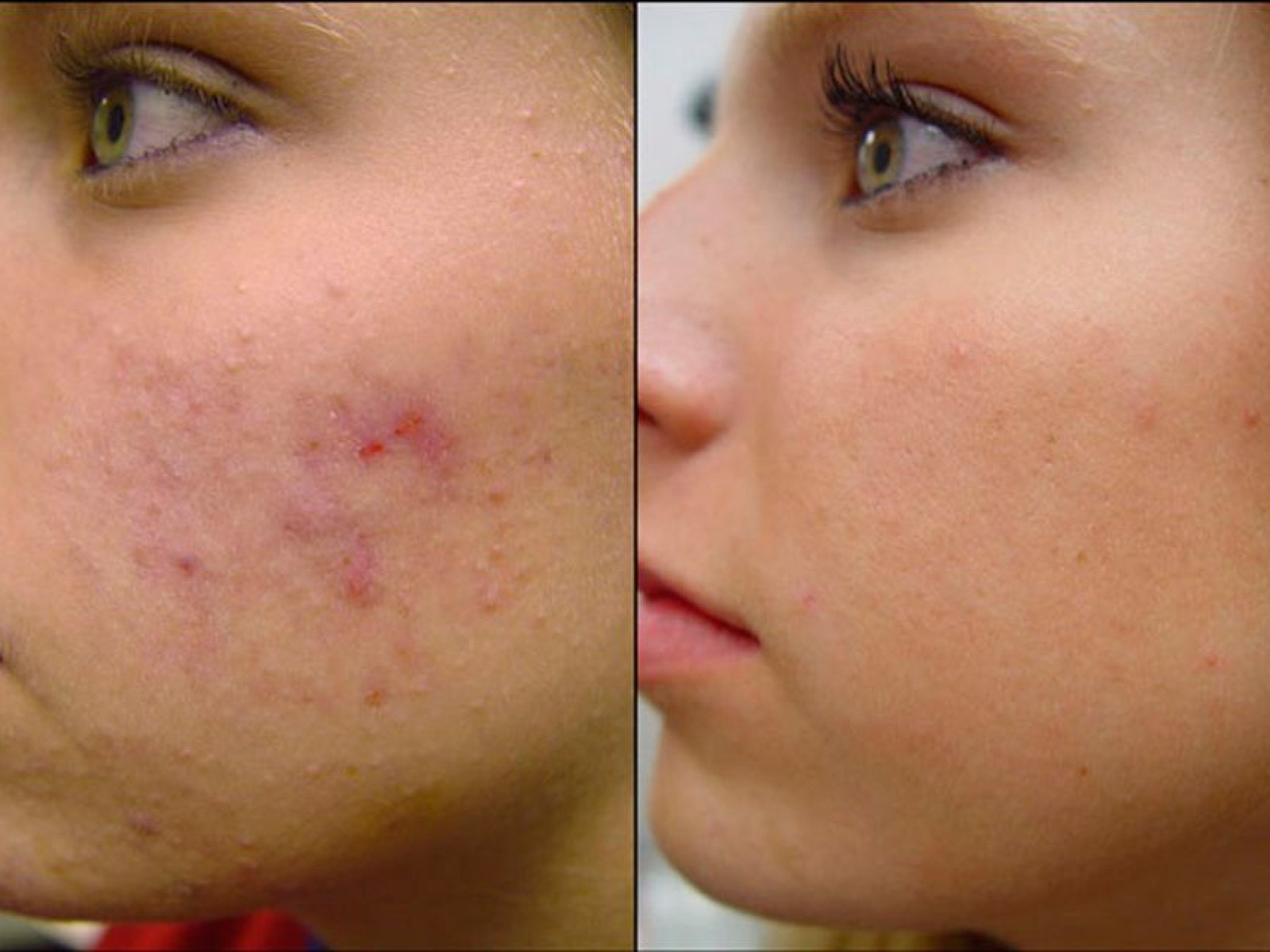 What Causes Cheek Acne And How To Prevent Them