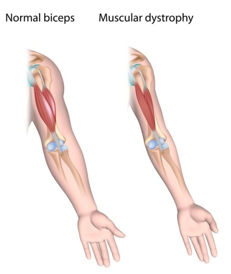 dystrophic-arm-muscle