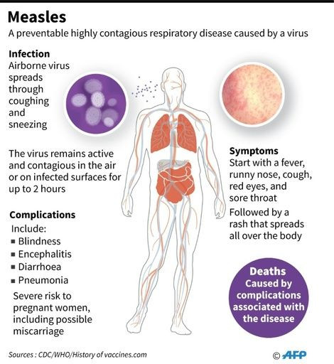Factfile on measles.