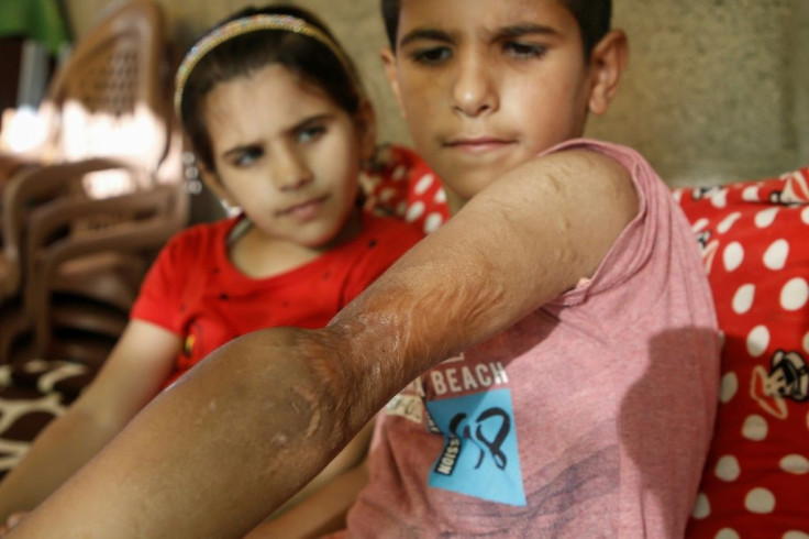 Yamin has faced mockery at school because of his scars