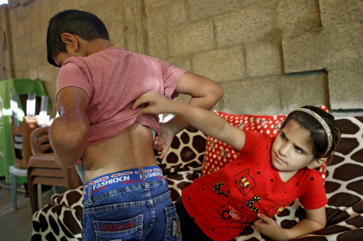 The skin on Yamin's back is still scarred from the burns he suffered in 2014