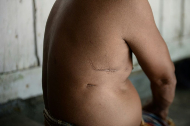 Hajeeding Maiseng, who took part in the protest, still bears the scars and cannot work properly in his rubber plantation