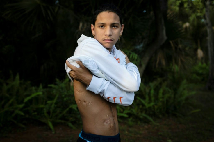 Anthony Borges shows his injuries from the Parkland shooting in February 2018