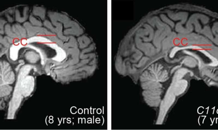 Genetic Brain Disorders 