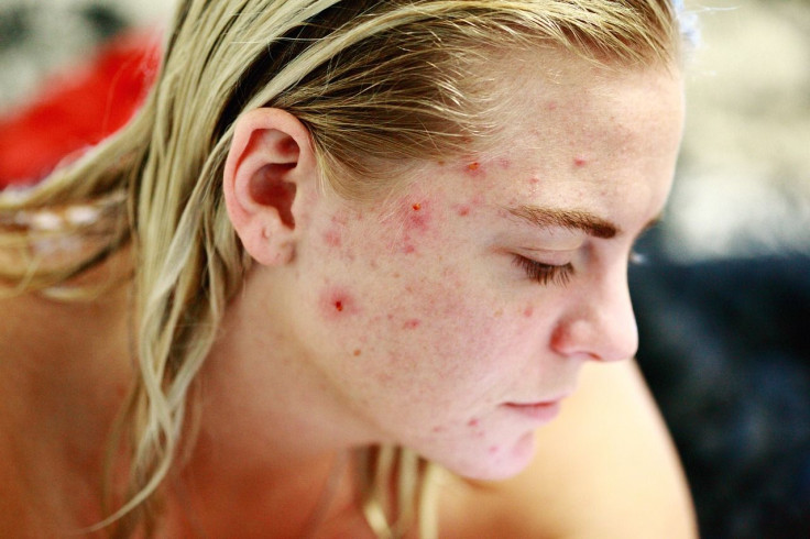 eczema, acne, natural treatment, honey,