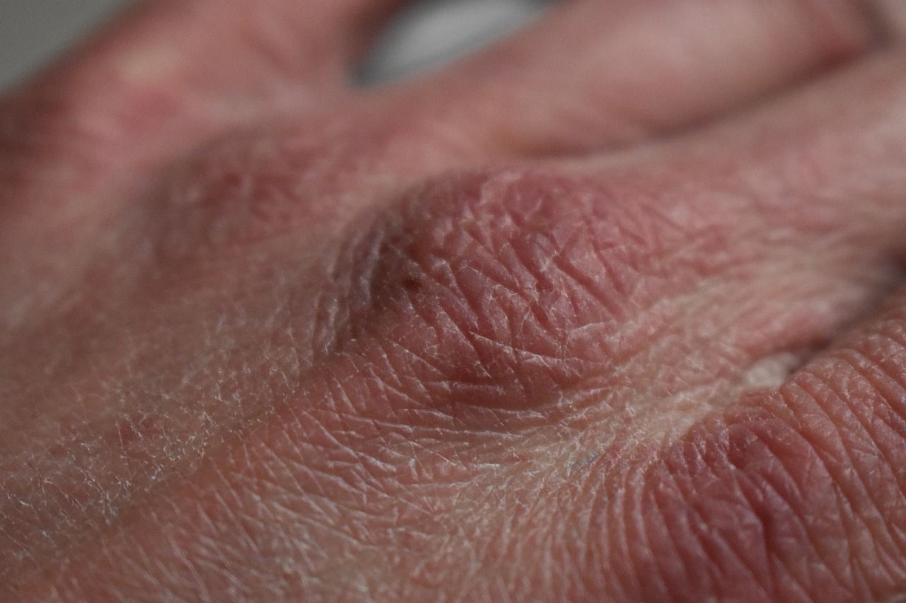 Skin Warning Signs That May Indicate You Have Vitamin D Deficiency 