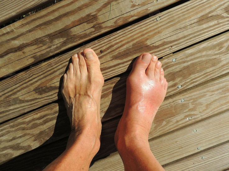 ankle swelling type 2 diabetes