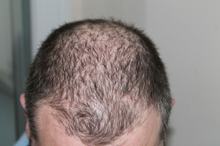 hair loss and high blood pressure