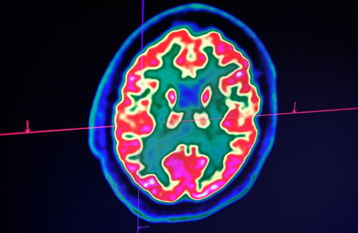 A picture of a human brain taken by a positron emission tomography scanner