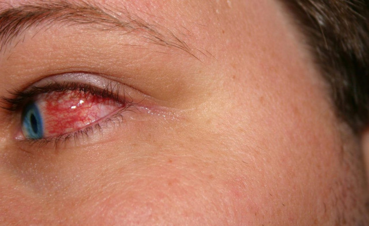 coronavirus can also exist in eye fluids according to research