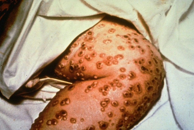 A close-up view of smallpox lesions on a person's leg