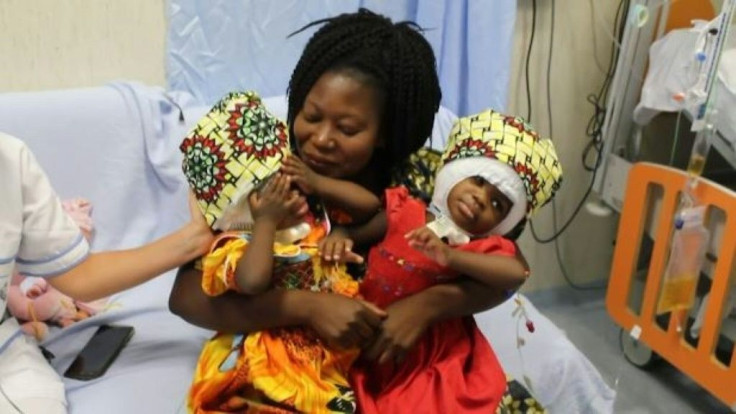 Joined skull to skull, sisters Ervina and Prefina were born with a condition the Bambino Gesu (Baby Jesus) Pediatric Hospital in Rome called "one of the rarest and most complex forms of cranial and cerebral fusion"